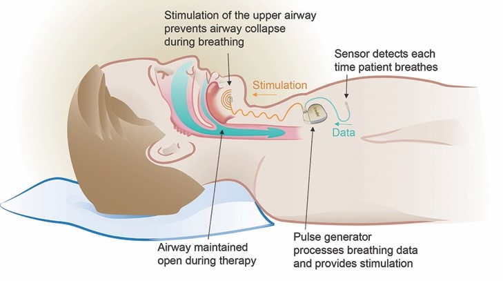 An upper airway stimulation approach to sleep apnea works inside the patient’s body. It involves a small implantable pacemaker-like device which stabilizes the throat while sleeping by providing gentle stimulation to throat muscles and allowing the airway to remain open during sleep.